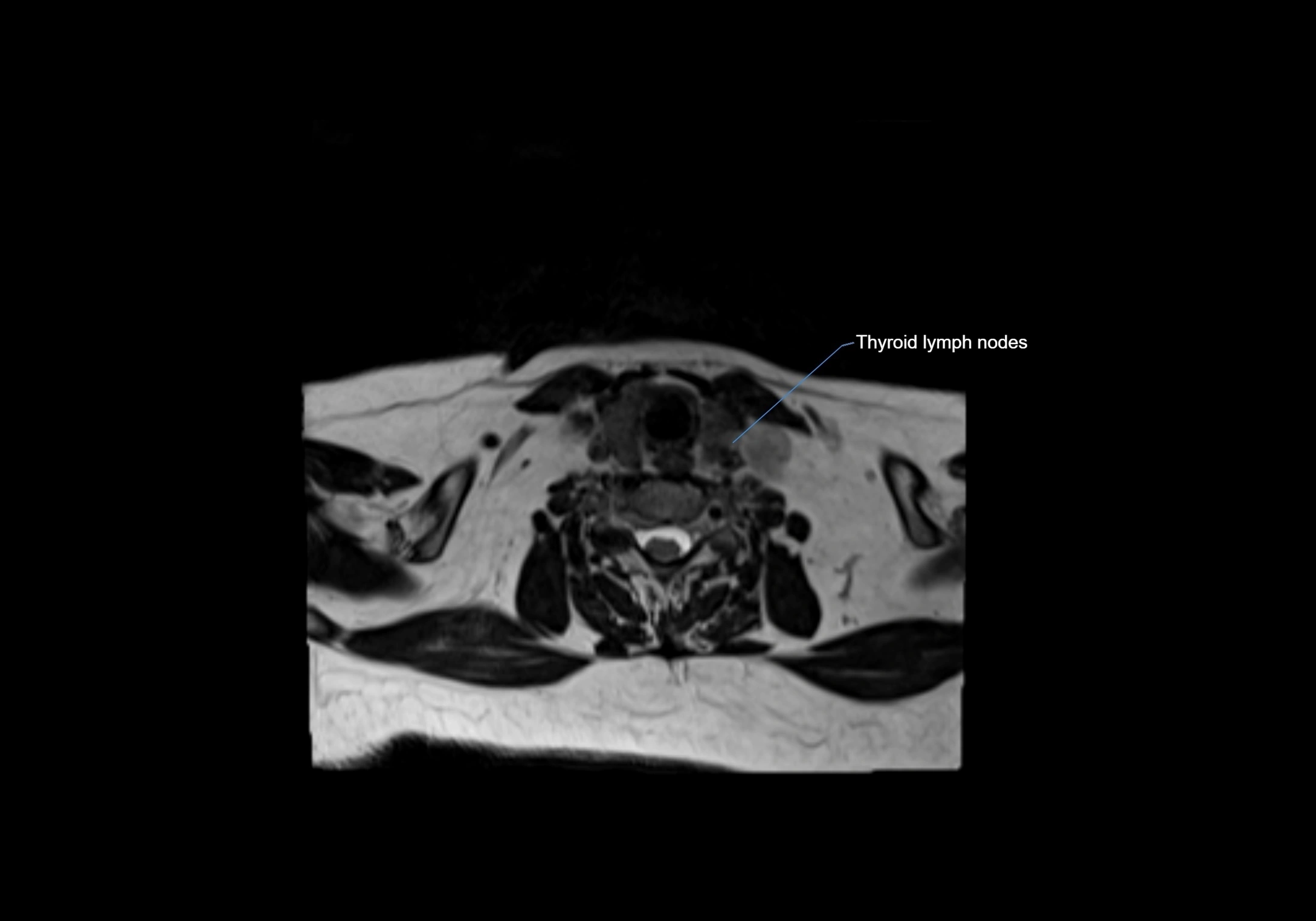 Neck axial  lymph node cross sectional MRI anatomy 3T MRI  image-img-00001-00076.webp